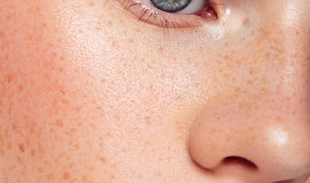 난치성 색소 클리닉